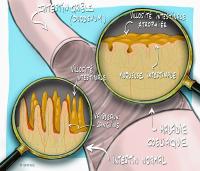 maladie_coeliaque_illustration_o_juanati_-_c_snfge_bd.jpg