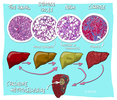 carcinome_hepatocellulaire_illustration_o._juanati_-_copyright_snfge.png