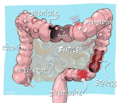 diverticulose_illustration_o_juanati_-_c_snfge_bd.jpg