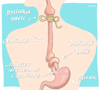 dysphagie_illustration_o_juanati_-_c_snfge_bd.jpg