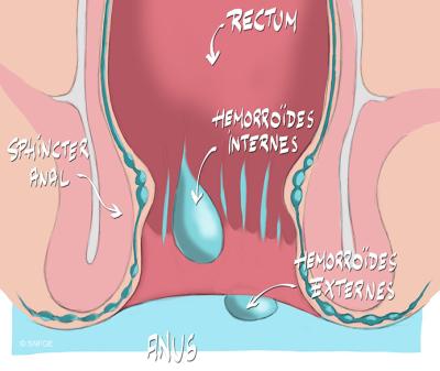 hemorroides_illustration_o_juanati_-_c_snfge_bd.jpg