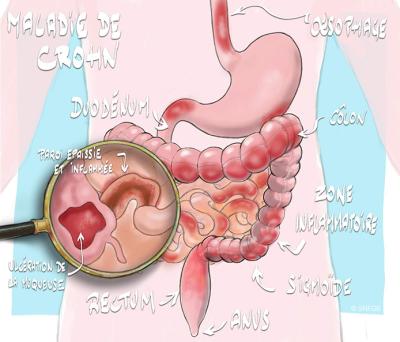 maladie_de_crohn_illustration_o_juanati_-_c_snfge_bd.jpg