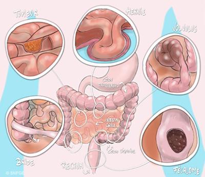 occlusion_intestinale_aigue_illustration_o_juanati_-_c_snfge_bd.jpg