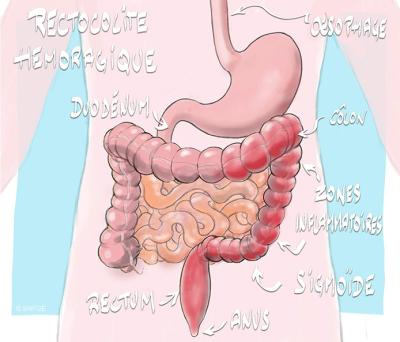 rectocolite_hemorragique_illustration_o_juanati_-_c_snfge_bd.jpg