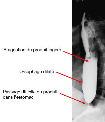 achalasie_tranit_baryte.jpg