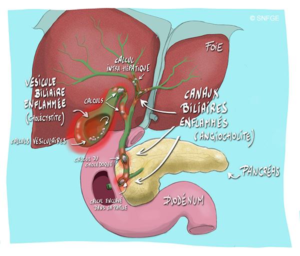 angiocholite_et_cholecystite_illustration_o_juanati_-_c_snfge_bd.jpg