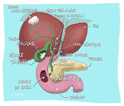 cholangiocarcinome_illustration_o._juanati_-_copyright_snfge.jpeg