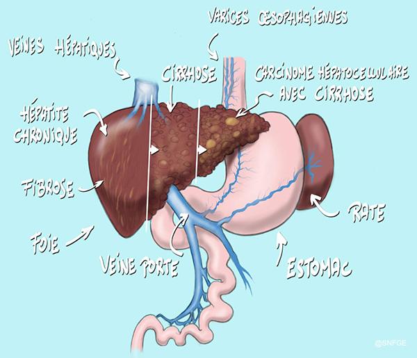 cirrhose_illustration_olivier_juanati_-_c_snfge_bd.jpg