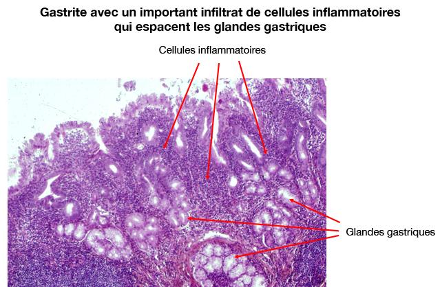 coupe_histologique_estomac-gastrite-2_droits_g_belleannee_a_de_mascarel.jpg