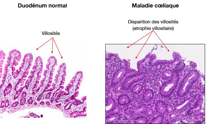 coupe_histologique_villosites-maladie_coeliaque_droits_g_belleannee.jpg