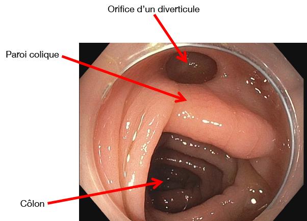 diverticule.jpg