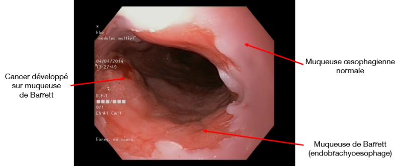 endoscopie_cancer_oesophage_droits_f_zerbib.jpg