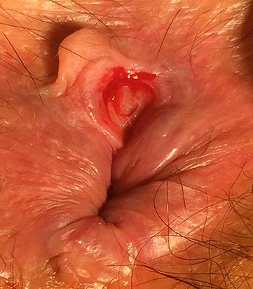 fissure_chronique_droits_n_fathallah_bd.jpg