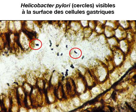 helicobacter_pylori_droits_g_belleannee_a_de_mascarel.jpg