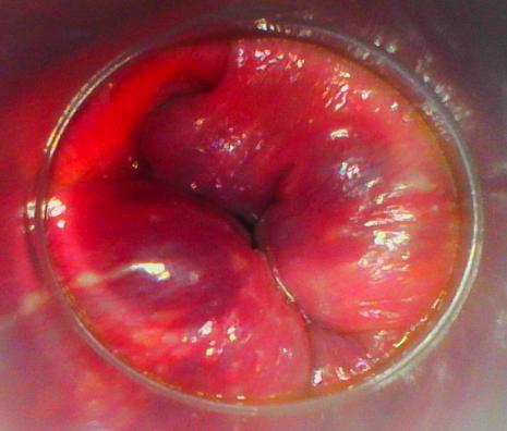 hemorroides-internes-inflammatoires_droits_v_de_parades.jpg