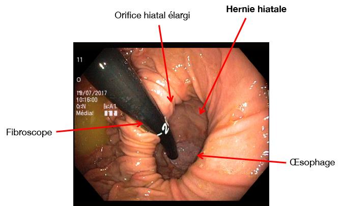 hernie_hiatale.jpg