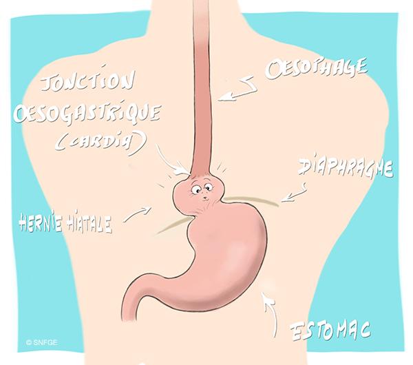 hernie_hiatale_par_glissement_illustration_o_juanati_-_c_snfge_bd.jpg
