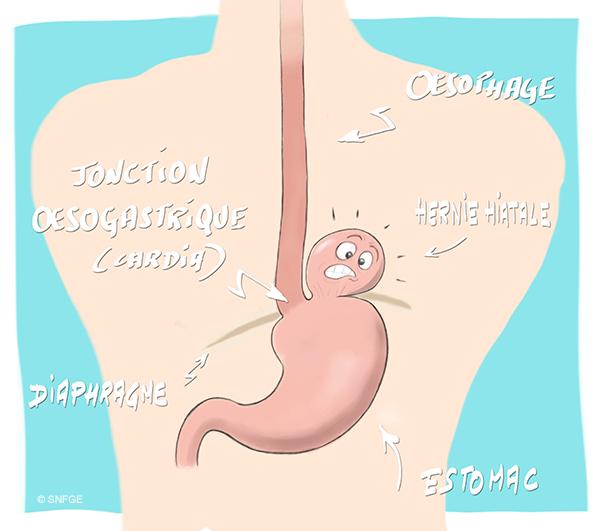 hernie_hiatale_par_roulement_illustration_o_juanati_-_c_snfge_bd.jpg