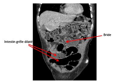 occlusion_intestin_grele_sur_bride.jpg