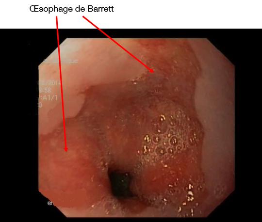 oesophage_de_barrett.jpg