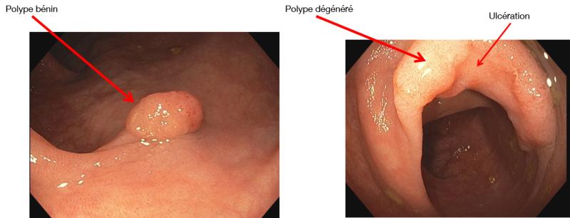 polype_degenere.jpg