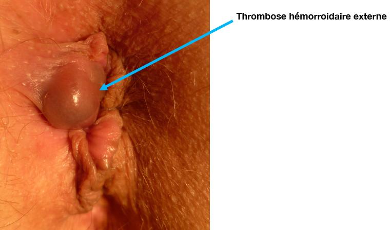 thrombose-hemorroidaire-externe_droits_v_de_parades.jpg